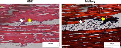 Ultrasound-assisted laser therapy for selective removal of melanoma cells